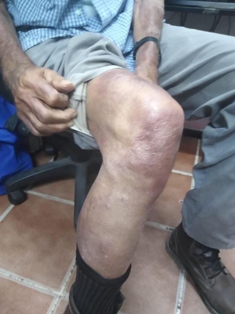 ISEM reconoce primer caso de lepra en más de un año; señala que está bajo control