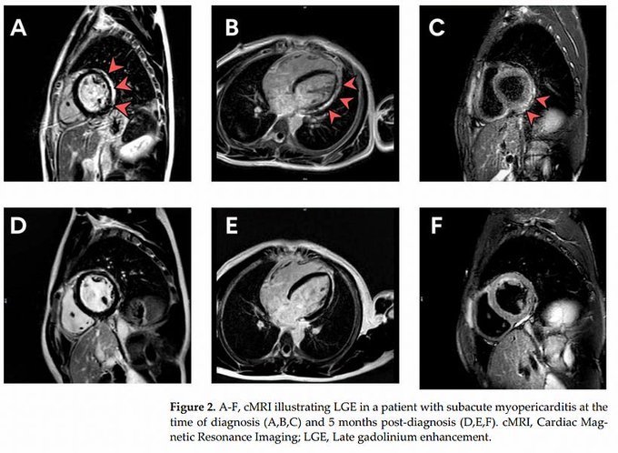 OJO: Primer país en investigar incidencia de miocarditis en adolescentes vacunados se lleva una sorpresa